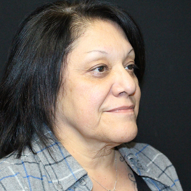 Blepharoplasty Before & After Image