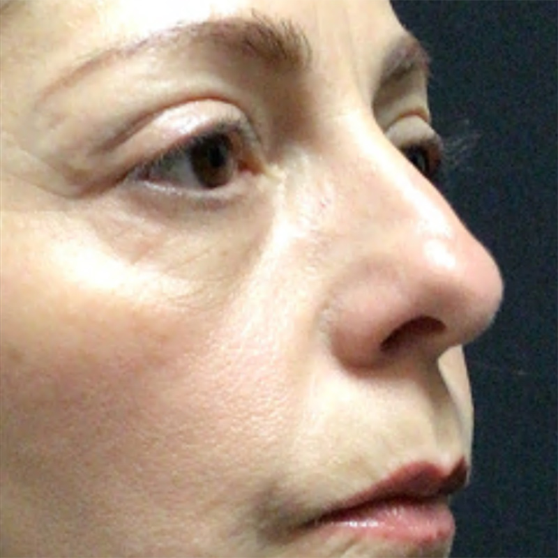 Blepharoplasty Before & After Image