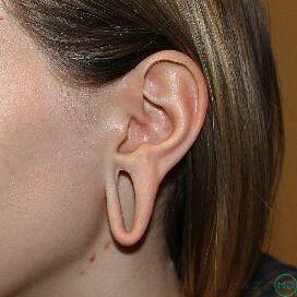 Earlobe Reduction Before & After Image