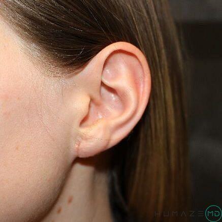 Earlobe Reduction Before & After Image