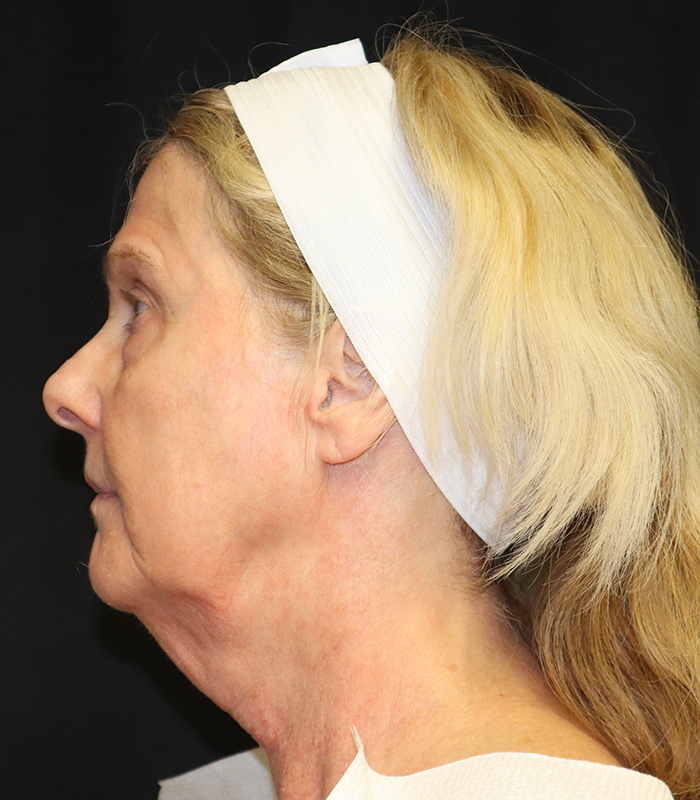 Facelift Before & After Image