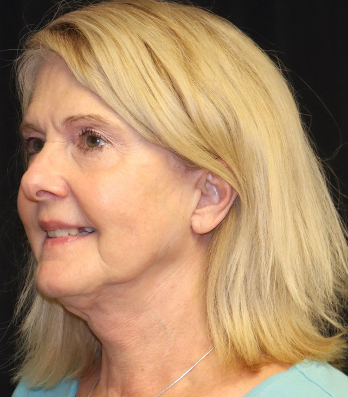 Facelift Before & After Image