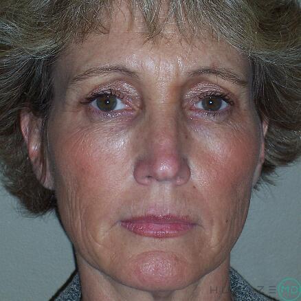 Facelift Before & After Image