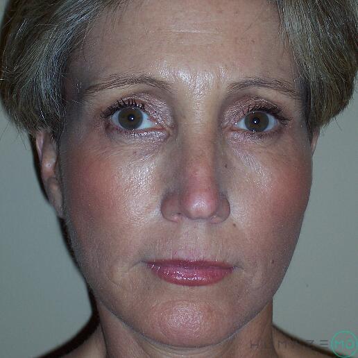 Facelift Before & After Image