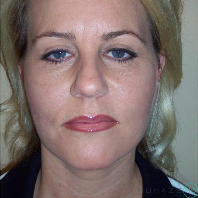 Facelift Before & After Image