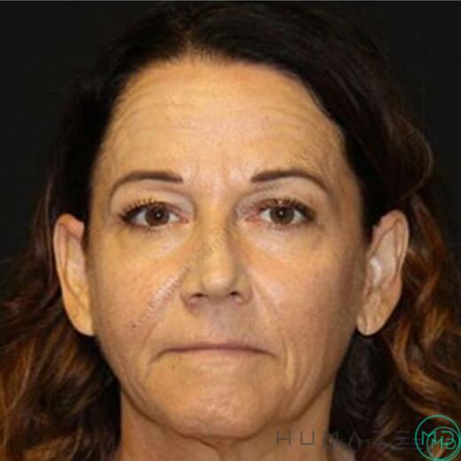 Facelift Before & After Image