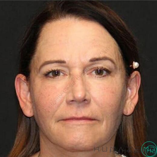 Facelift Before & After Image