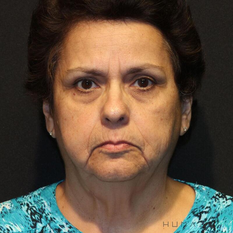 Facelift Before & After Image