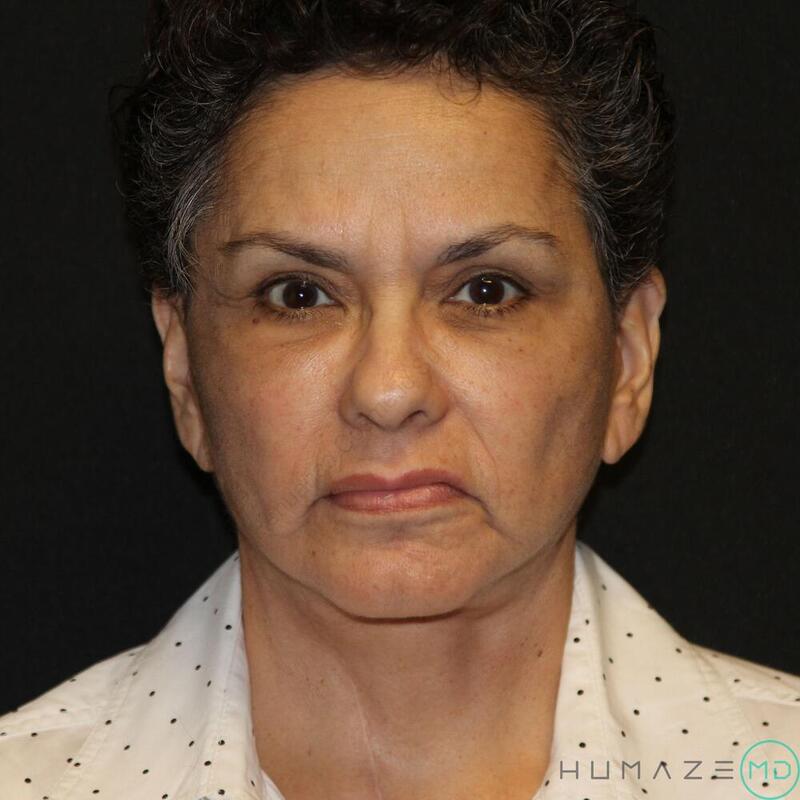 Facelift Before & After Image