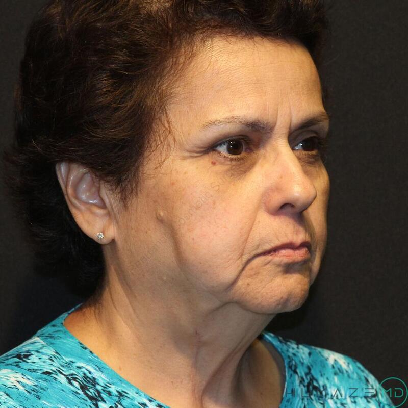 Facelift Before & After Image