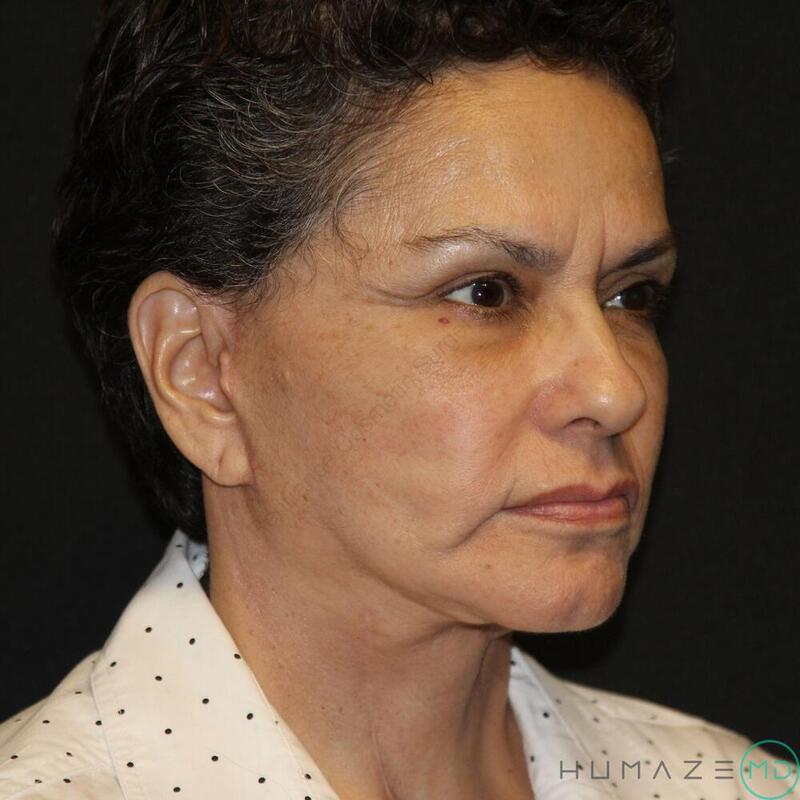 Facelift Before & After Image