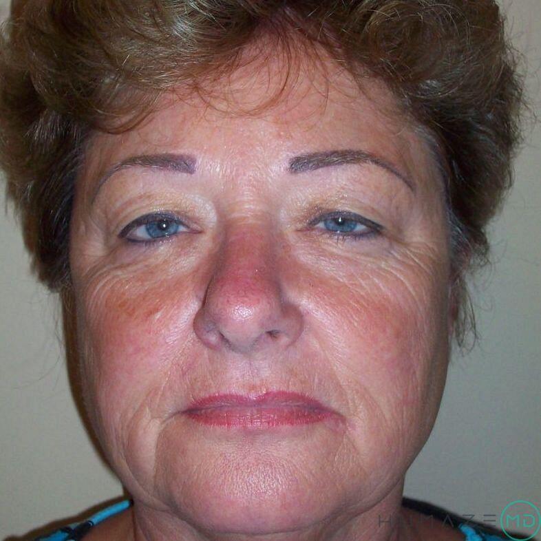 Facelift Before & After Image