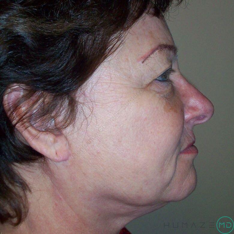 Facelift Before & After Image