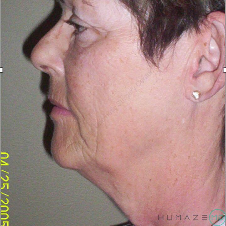 Facelift Before & After Image