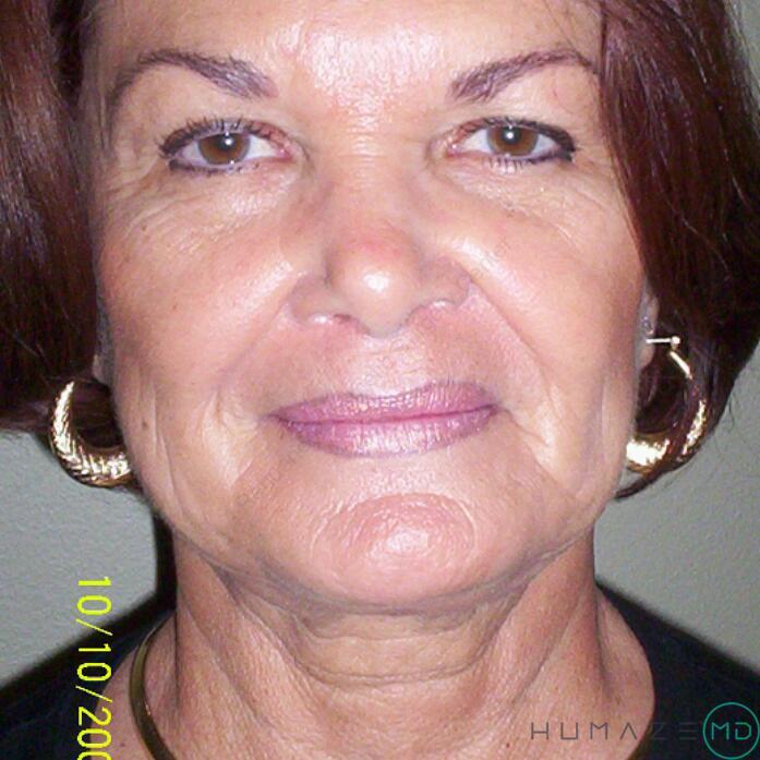Facelift Before & After Image