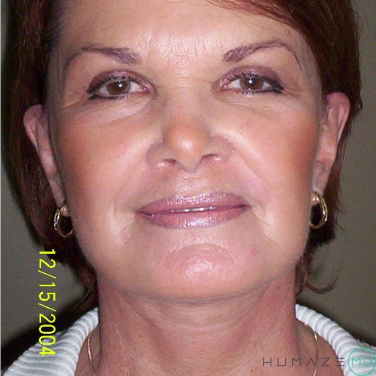 Facelift Before & After Image