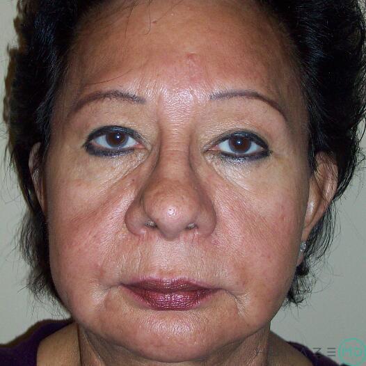 Mini Facelift Before & After Image
