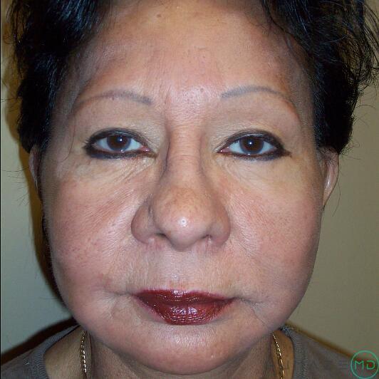 Mini Facelift Before & After Image
