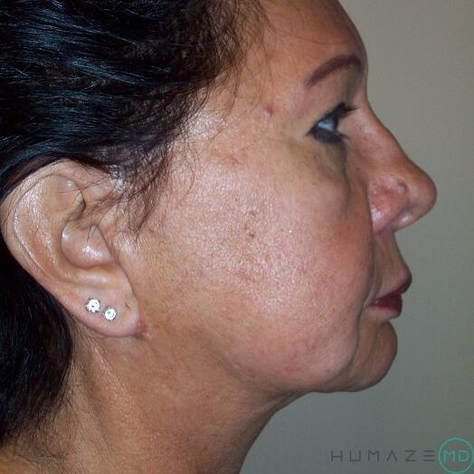 Mini Facelift Before & After Image