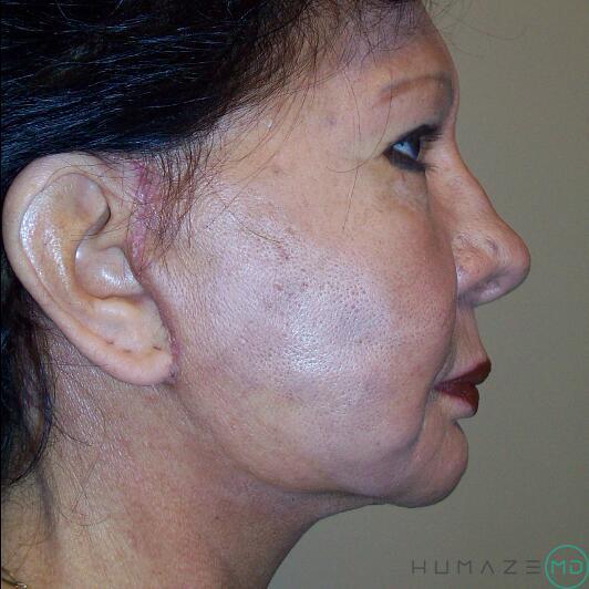 Mini Facelift Before & After Image