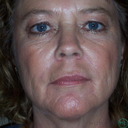 Mini Facelift Before & After Image