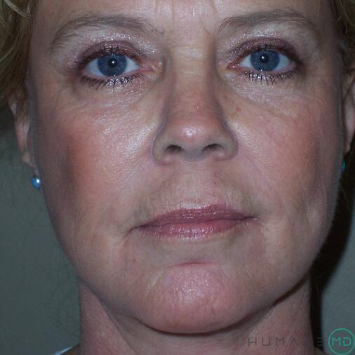 Mini Facelift Before & After Image