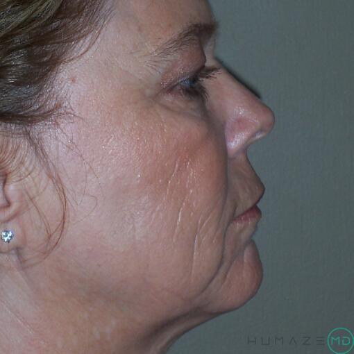 Mini Facelift Before & After Image