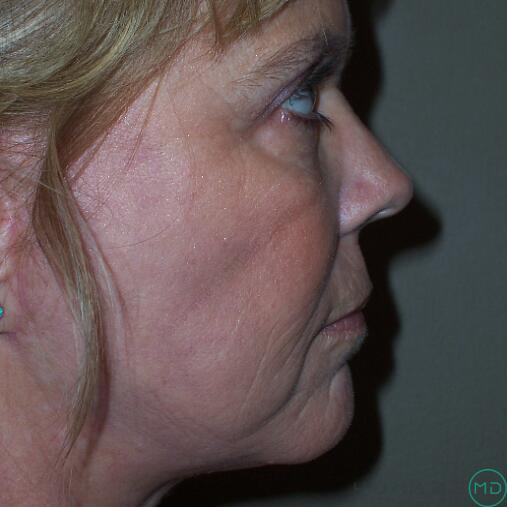 Mini Facelift Before & After Image