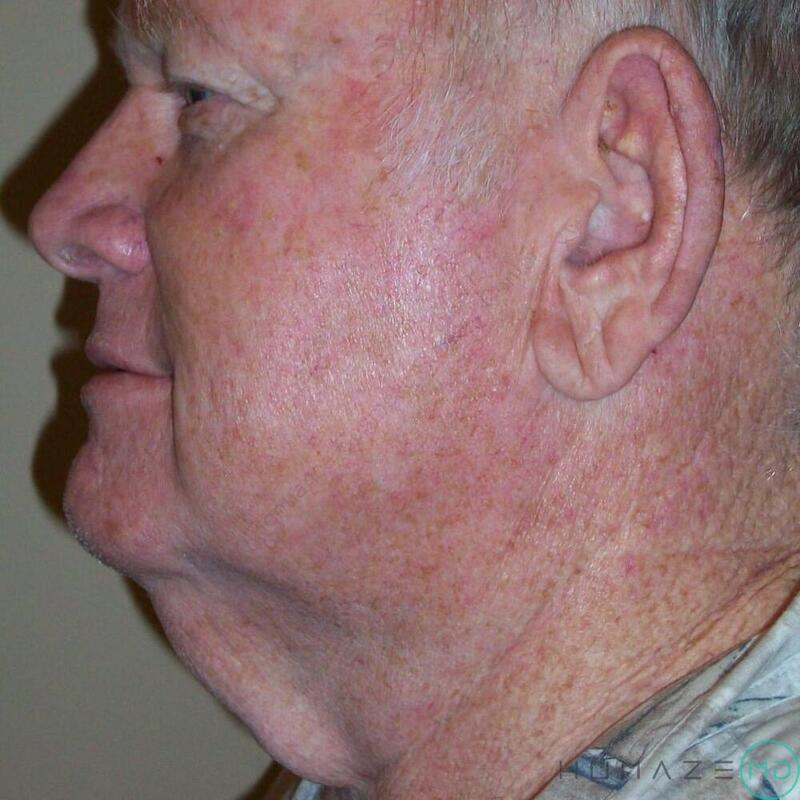 Neck Lift Before & After Image