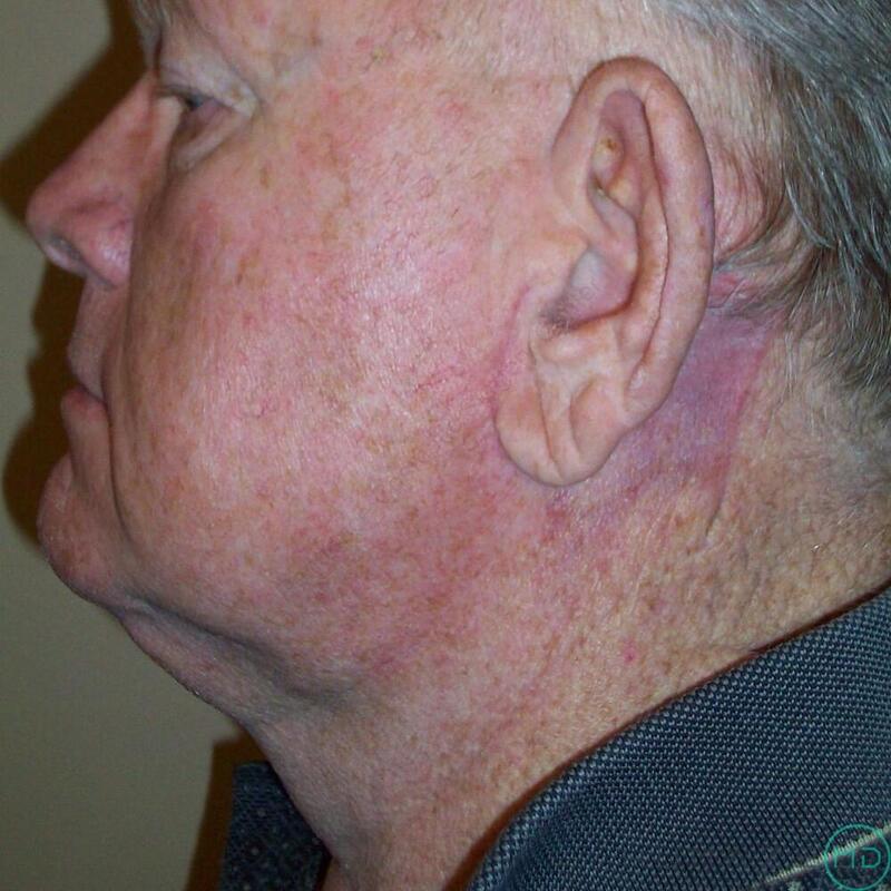 Neck Lift Before & After Image