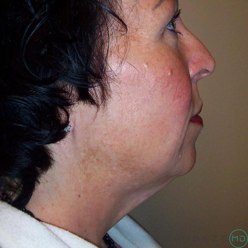 Neck Lift Before & After Image