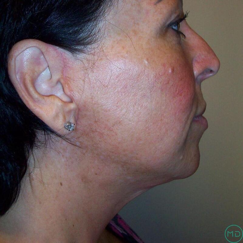 Neck Lift Before & After Image