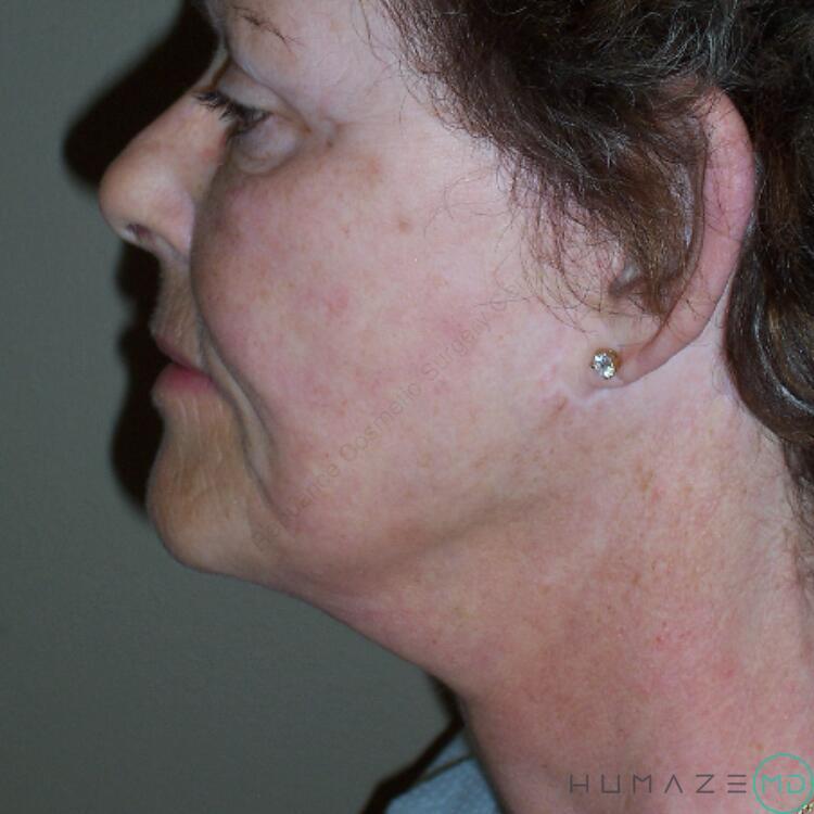 Neck Lift Before & After Image
