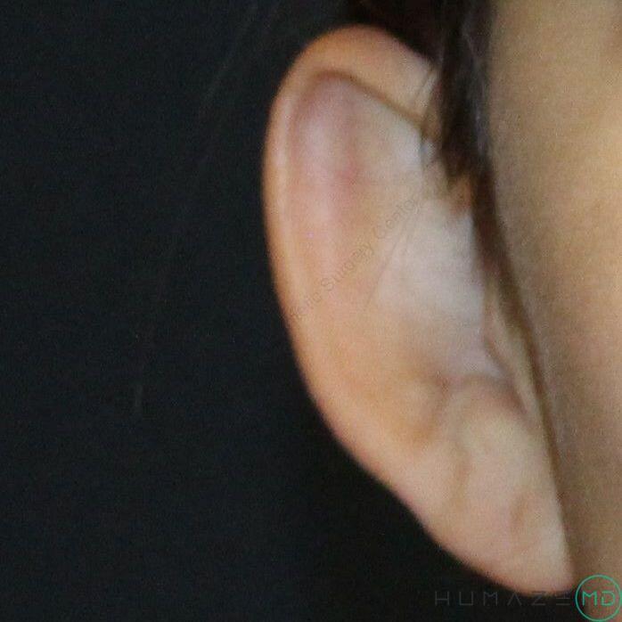 Otoplasty Before & After Image