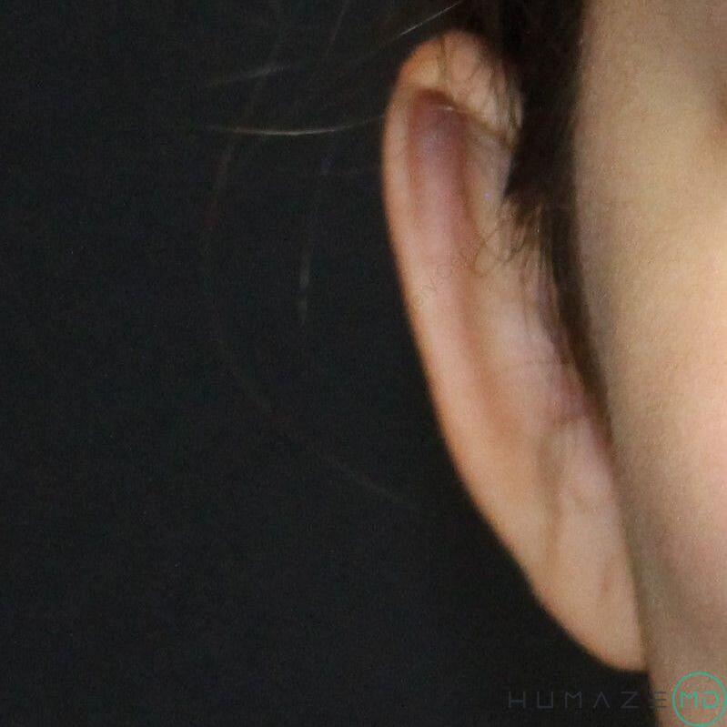 Otoplasty Before & After Image