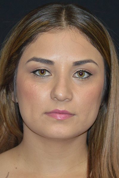 Rhinoplasty Before & After Image