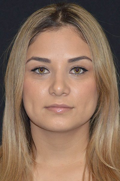 Rhinoplasty Before & After Image