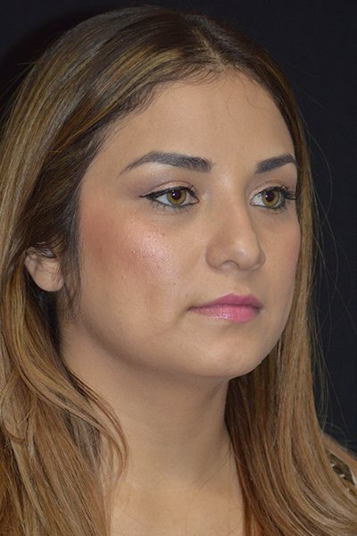 Rhinoplasty Before & After Image