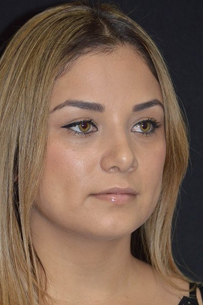 Rhinoplasty Before & After Image