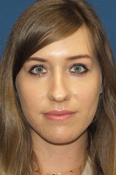 Rhinoplasty Before & After Image