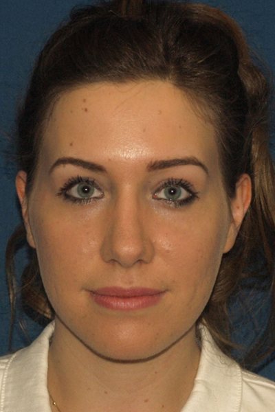 Rhinoplasty Before & After Image