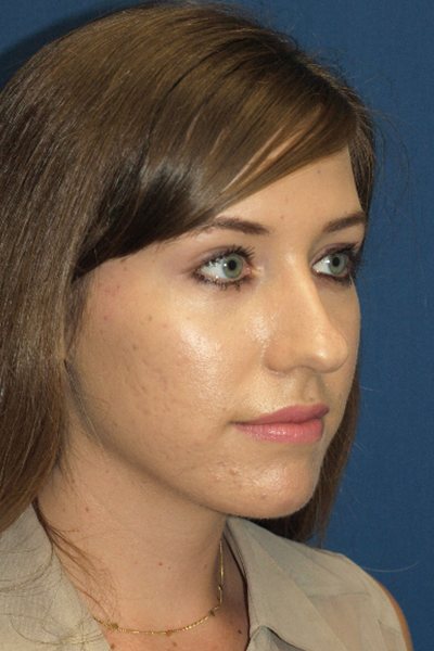 Rhinoplasty Before & After Image