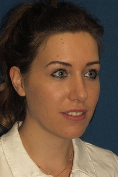 Rhinoplasty Before & After Image