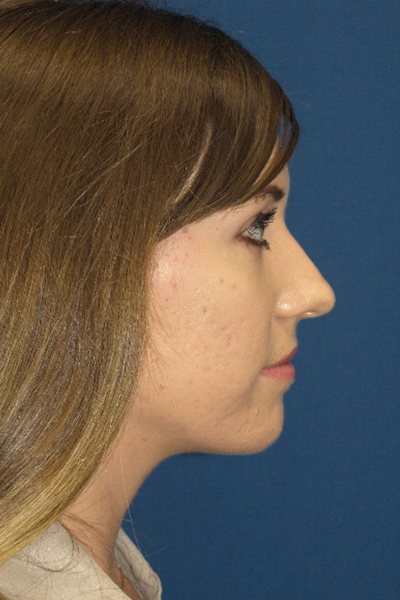 Rhinoplasty Before & After Image