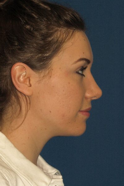 Rhinoplasty Before & After Image