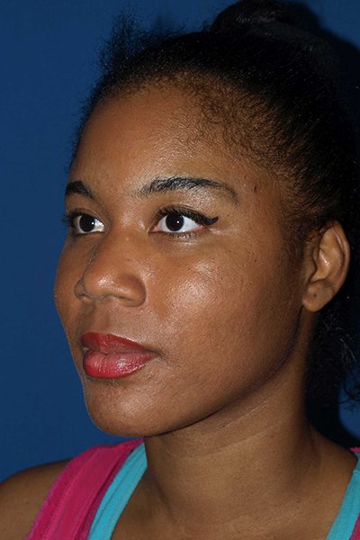 Rhinoplasty Before & After Image