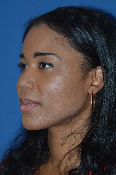 Rhinoplasty Before & After Image