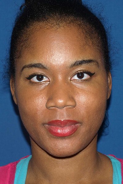 Rhinoplasty Before & After Image