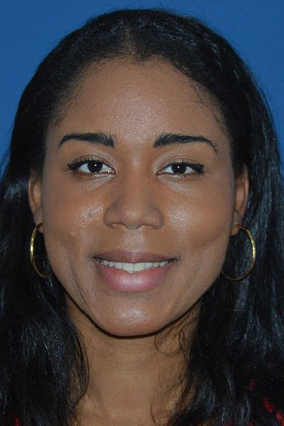 Rhinoplasty Before & After Image