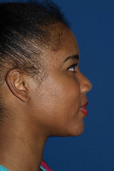 Rhinoplasty Before & After Image